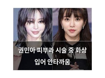 권민아 피부과 시술 중 화상 입어 안타까움